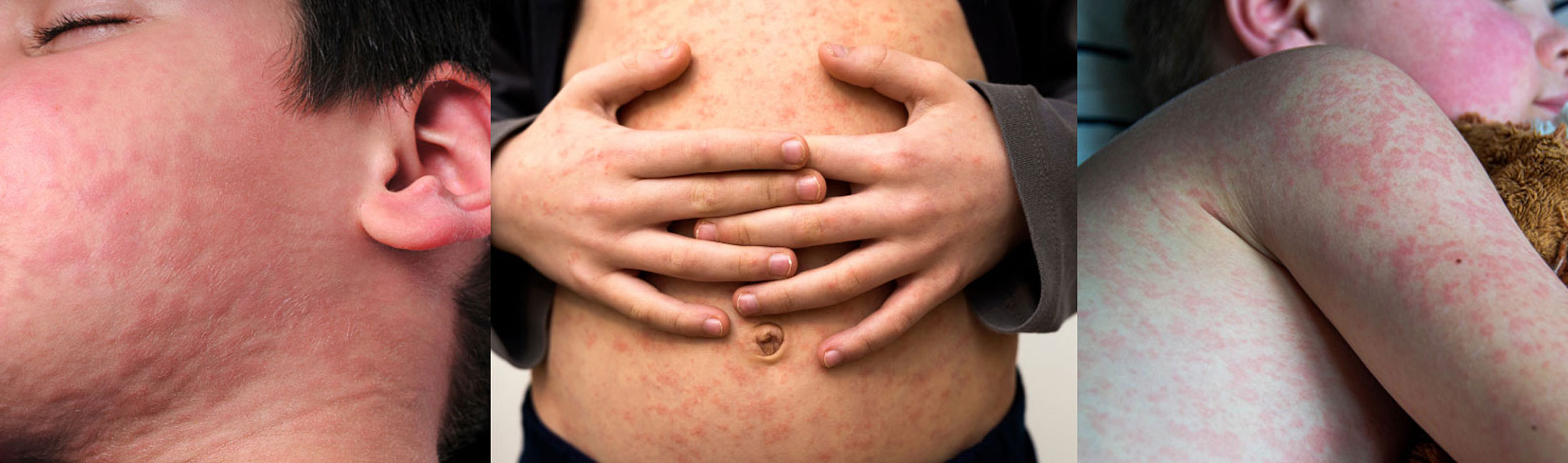 three photos of measles on skin 